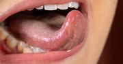 Masz biały nalot na języku? Endokrynolog: Pierwsza faza choroby