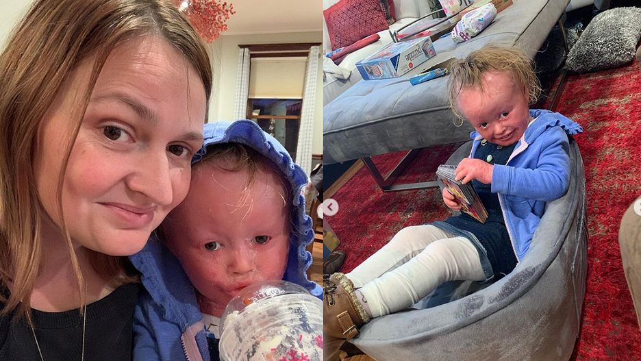 Dziewczynka z rzadkim schorzeniem podbija media społecznościowe. Anna czyli @harlequindiva dzielnie znosi chorobę