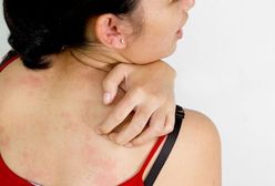 Choroby skóry – co zamiast sterydów?