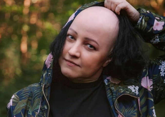 Marta Kawczyńska cierpi na łysienie plackowate
