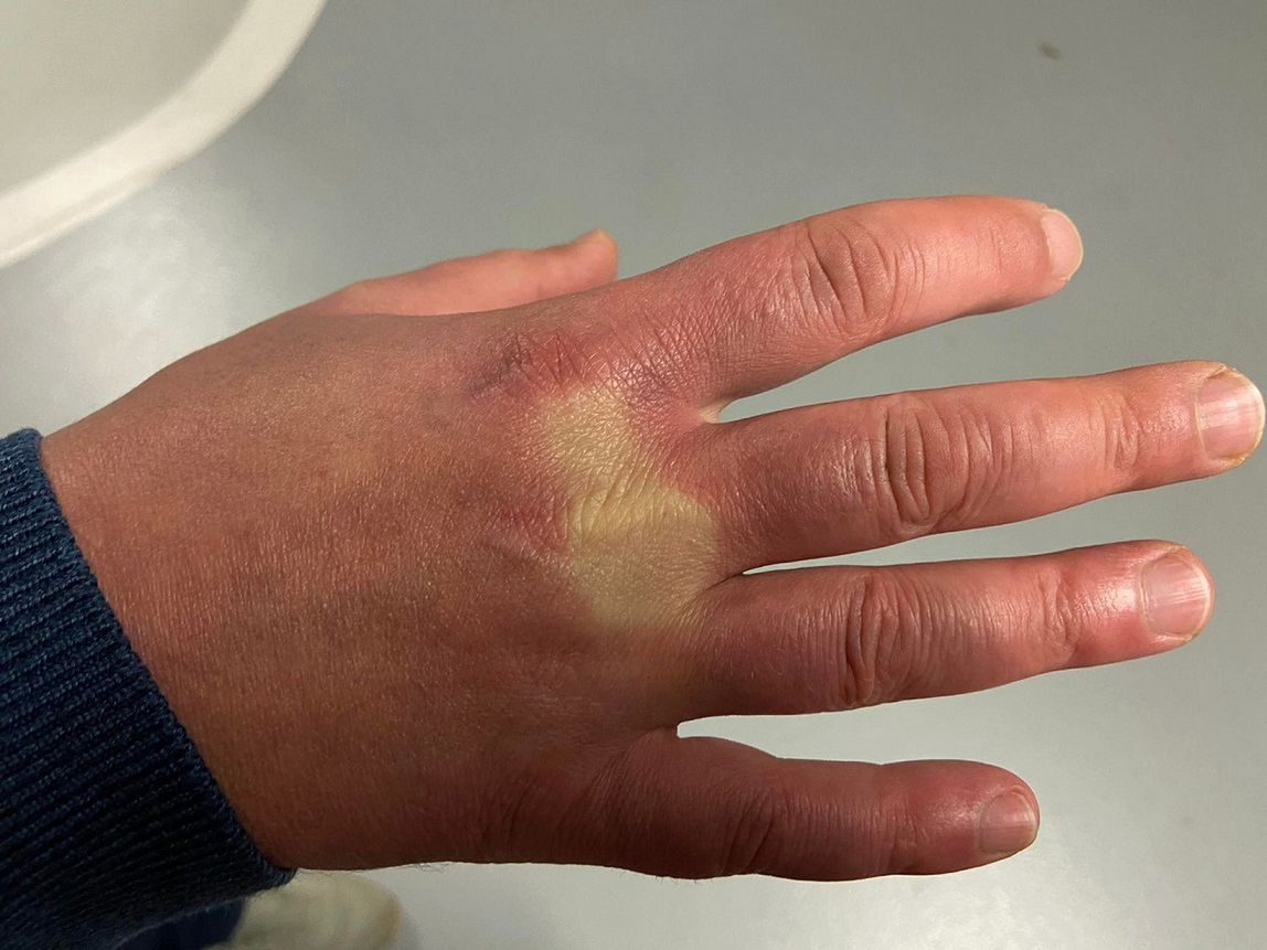Objaw widoczny na dłoniach