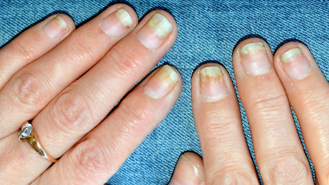 Olejowe plamy na paznokciach mogą świadczyć o chorobie