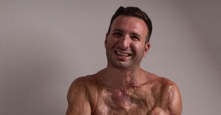Został porażony prądem. Miał stopioną skórę i zwęglone mięśnie. To cud, że żyje