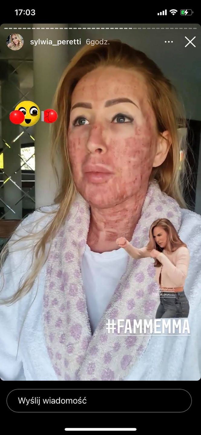 Sylwia Peretti po zabiegu laserowym