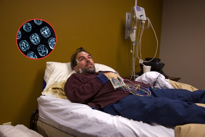 Zaburzenia snu fazy REM są najwcześniejszym objawem tego rodzaju demencji