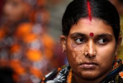 Kwasem spalono im twarze - ofiary potwornych ataków