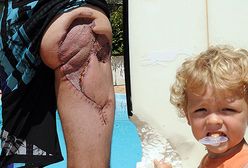 Pogryziony przez rekina