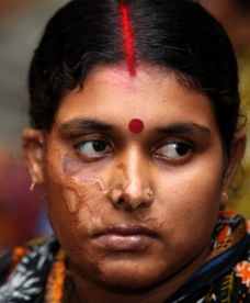 Kwasem spalono im twarze - ofiary potwornych ataków