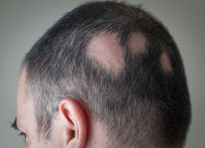 Alopecja najczęściej występuje na skórze owłosionej głowy