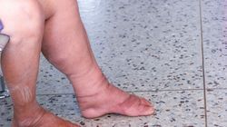 Pojawia się po jednej stronie ciała. Wygląd skóry odróżni go od zakrzepicy