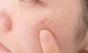 Sposób na przebarwienia? Tania maść z apteki działa cuda