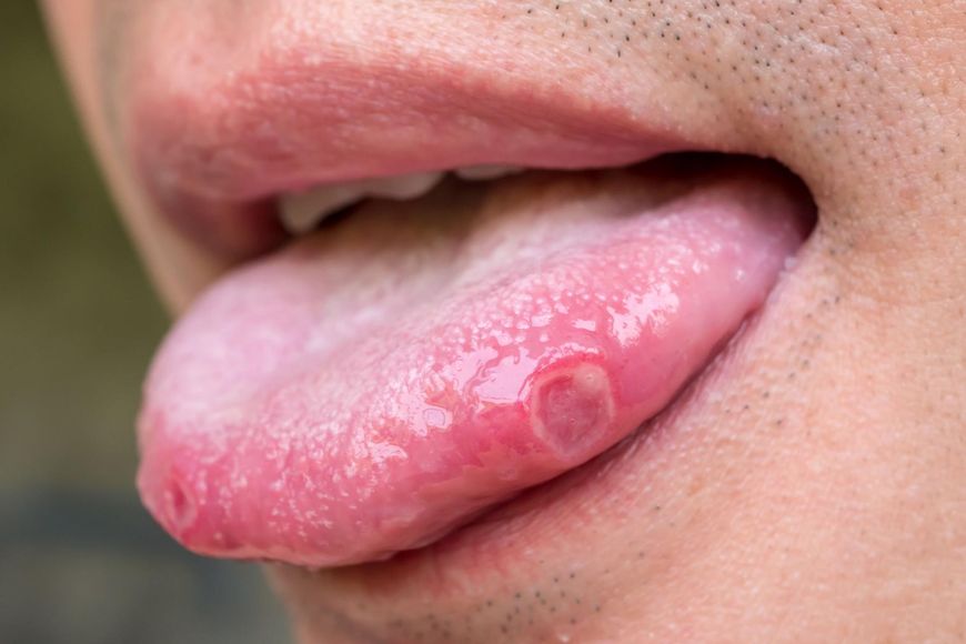 Rak języka. Objawy i przyczyny choroby