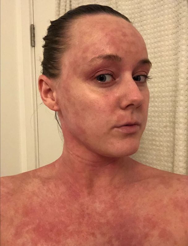 Stan skóry Beth gwałtownie pogorszył się po odstawieniu maści sterydowych