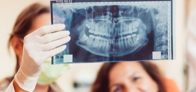 „Zęby mądrości” – kiedy lepiej je usunąć?