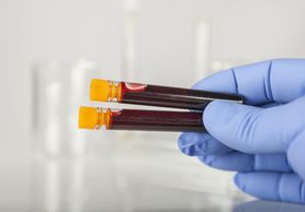 Biochemia krwi –  profile oznaczeń, normy