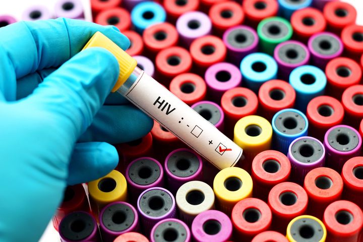 Wirus HIV: przyczyny, diagnostyka i leczenie