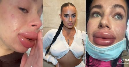 Influencerka powiększyła usta w barterze. Po zabiegu omal nie EKSPLODOWAŁY: "Najgorszy dzień w moim życiu" (FOTO)