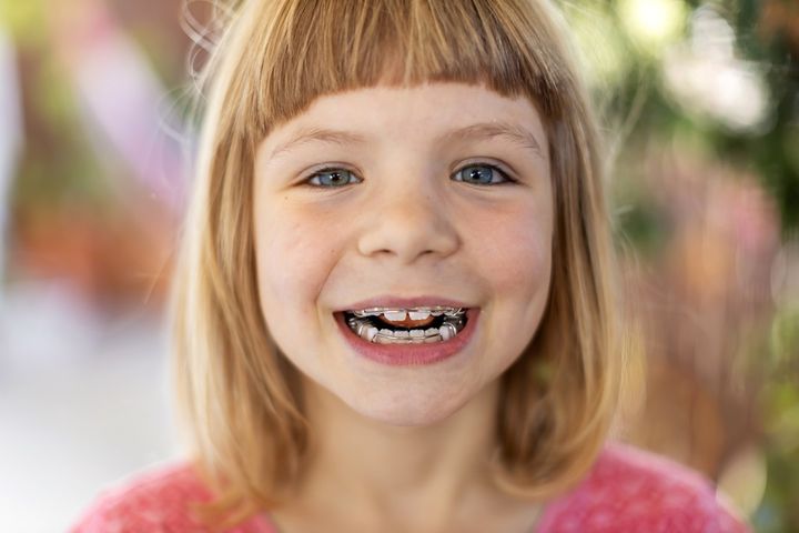 Aparat na zęby dla dzieci