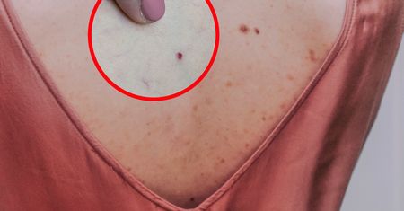Na twoim ciele pojawiły się "rubinki"? To może być sygnał alarmowy