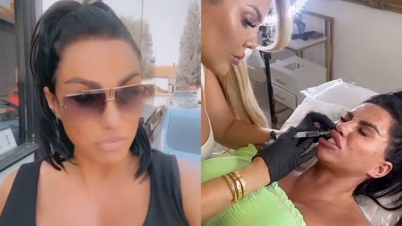 Katie Price podzieliła się efektem zabiegu rozpuszczenia kwasu w ustach