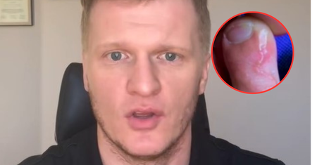 Niechciana pamiątka z wakacji. Lekarz ostrzega przed "czerwoną nitką pod skórą"