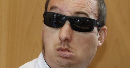 Przeszczep twarzy w Polsce. Pacjent marzy o domu i spokoju