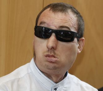 Przeszczep twarzy w Polsce. Pacjent marzy o domu i spokoju