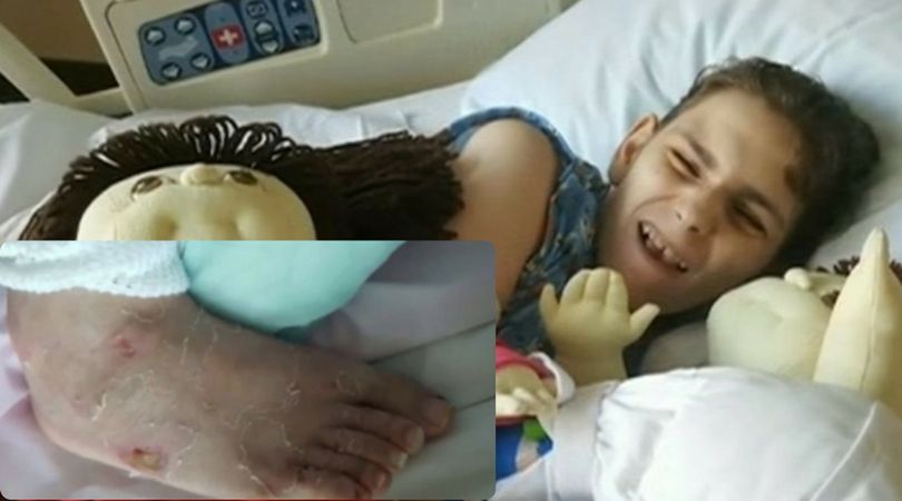 Niepełnosprawna 19-latka doznała poparzeń 3 stopnia. Jej opiekunowie wsadzili ją  do wanny z środkami chemicznymi