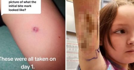 Zaczęło się od małej krostki. Lekarze nie chcieli wierzyć matce 9-latki