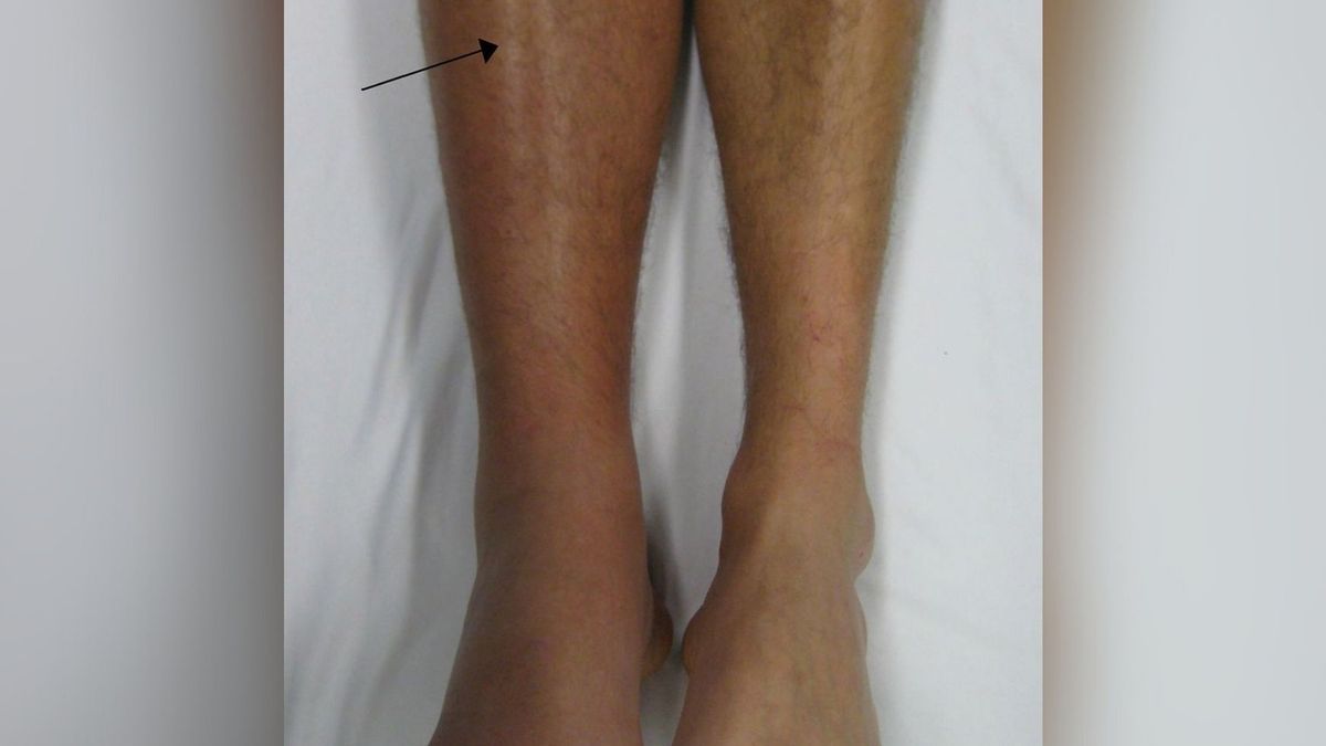 Główny objaw zakrzepicy to obrzęk, któremu towarzyszy ból