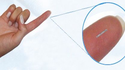 Glucowizzard - maleńki, zasilany energią solarną implant do kontroli poziomu glukozy we krwi 1