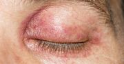 "Rumień na powiekach to nie są "tylko czerwone powieki". Lekarka ostrzega