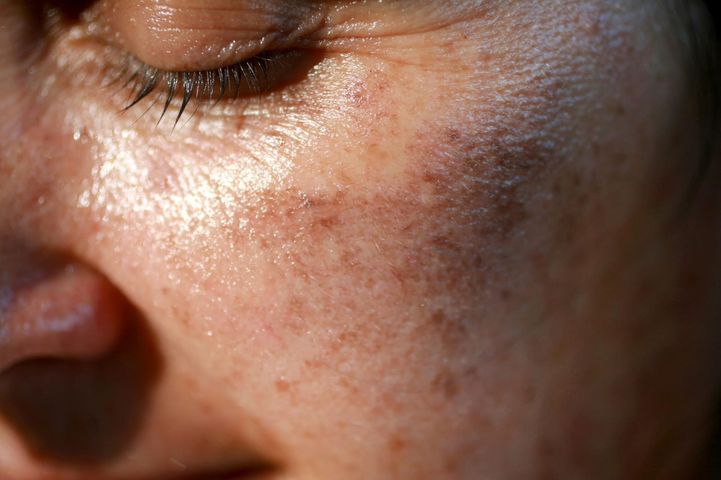 Skóra perganimowa to rzadka genetyczna choroba skóry, charakteryzująca się nadwrażliwością na promieniowanie UV.