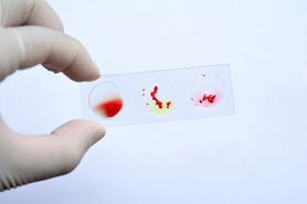 Co to jest aglutynacja? Grupy krwi i wskazania do określenia grupy krwi