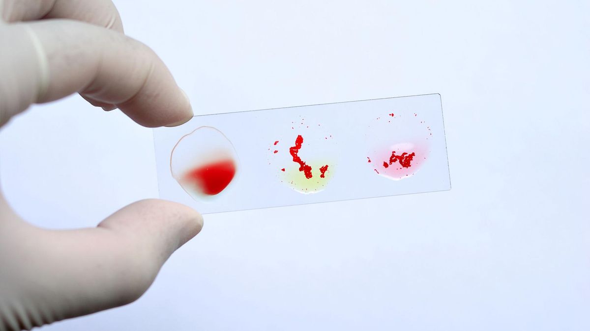 Aglutenacja to metoda stosowana do określenia grupy krwi. 