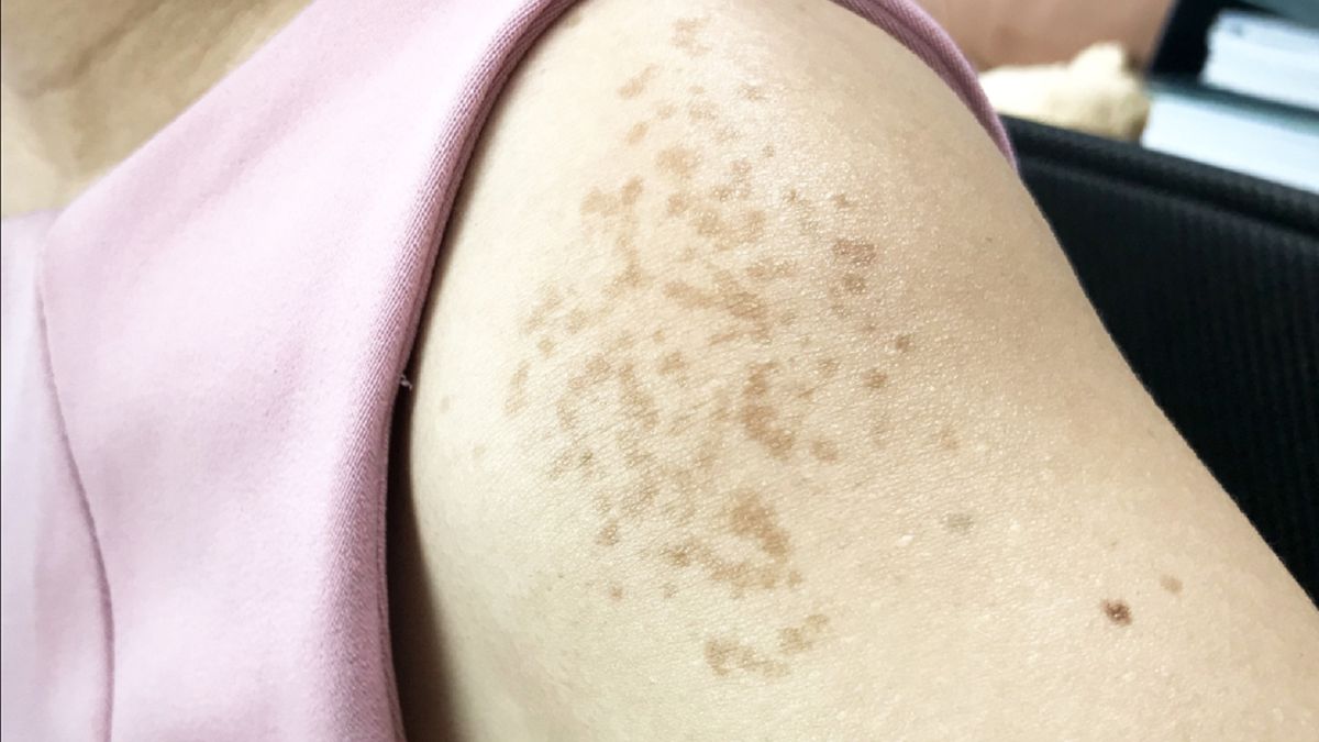 Plamy na ciele mogą ostrzegać o cukrzycy