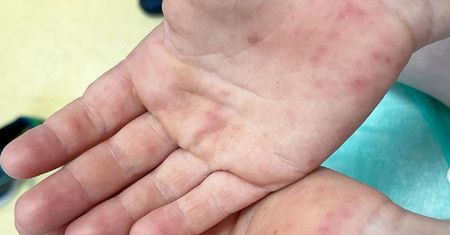 Czym jest choroba dłoni, stóp i ust? "Mama pediatra" tłumaczy