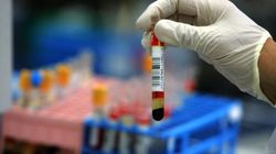 Chromogranina A - charakterystyka, badanie, norma. 