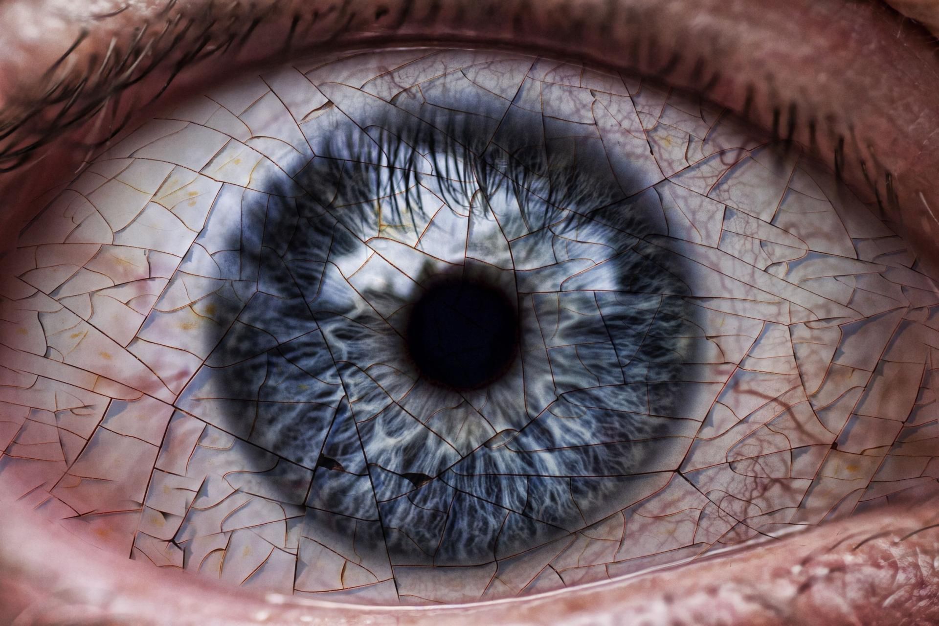 Pęknięte naczynko w oku zwykle zalecza się samo.