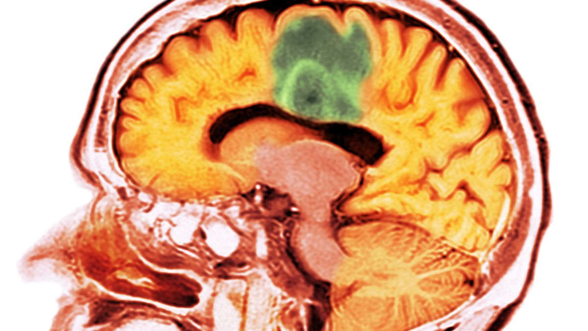 Naukowcy testują szczepionkę, która ma pomagać zwalczać guzy mózgu