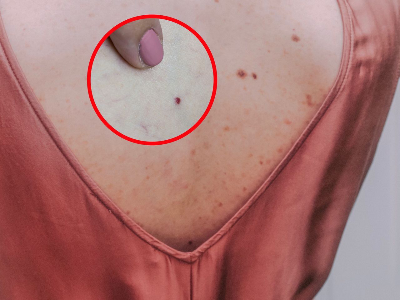 Na twoim ciele pojawiły się "rubinki"? To może być sygnał alarmowy