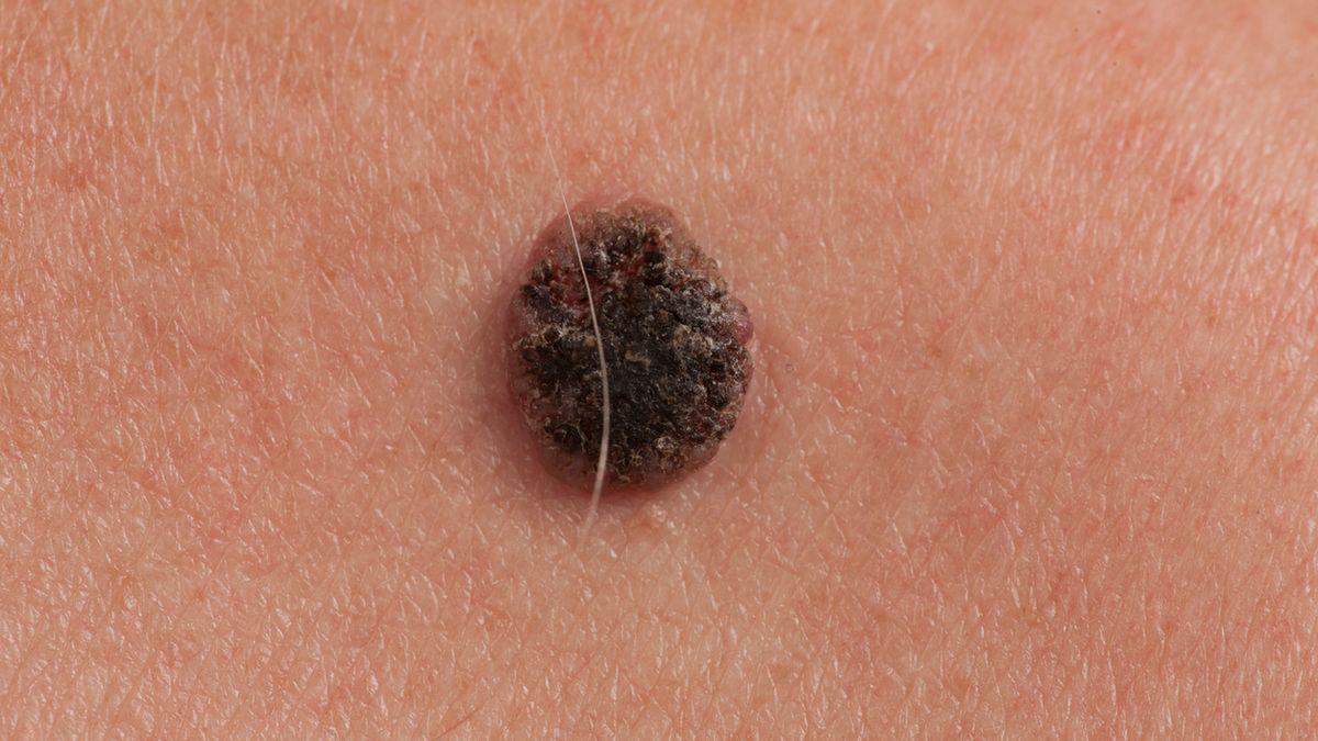 Zaniepokoić powinna każda zmiana na skórze, która ma nieregularne krawędzie i kształt, jest asymetryczna, ma niejednorodny kolor lub jej średnia jest większa niż 6 mm. 