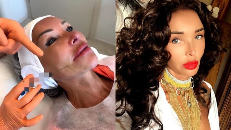 Ewa Minge prezentuje efekty zabiegu medycyny estetycznej 