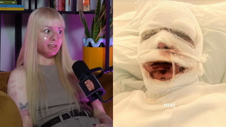 Płonęła żywcem. Teraz udzieliła wywiadu