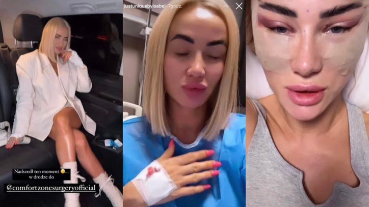 Izabela Macudzińska promuje turecką klinikę, w której poszła pod nóż