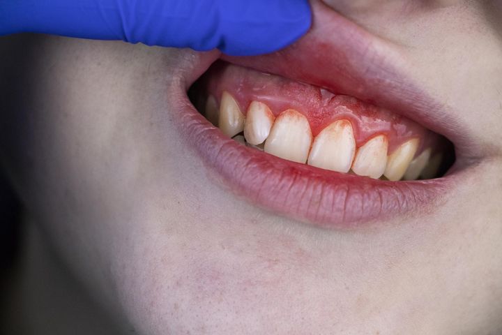 Odsłonięte szyjki zębowe doprowadzają do nadwrażliwości zębów, dlatego należy podjąć ich leczenie.