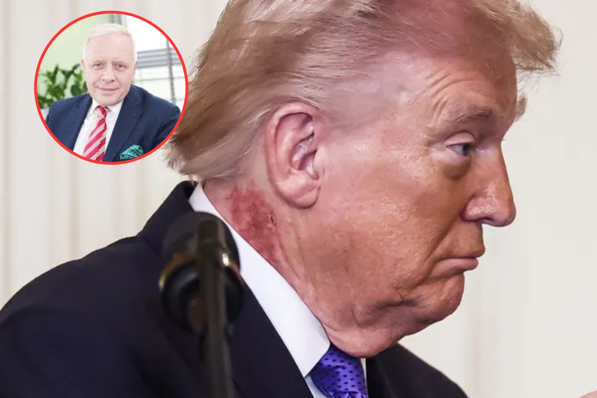 Zmiany na szyi Trumpa. Co oznaczają?