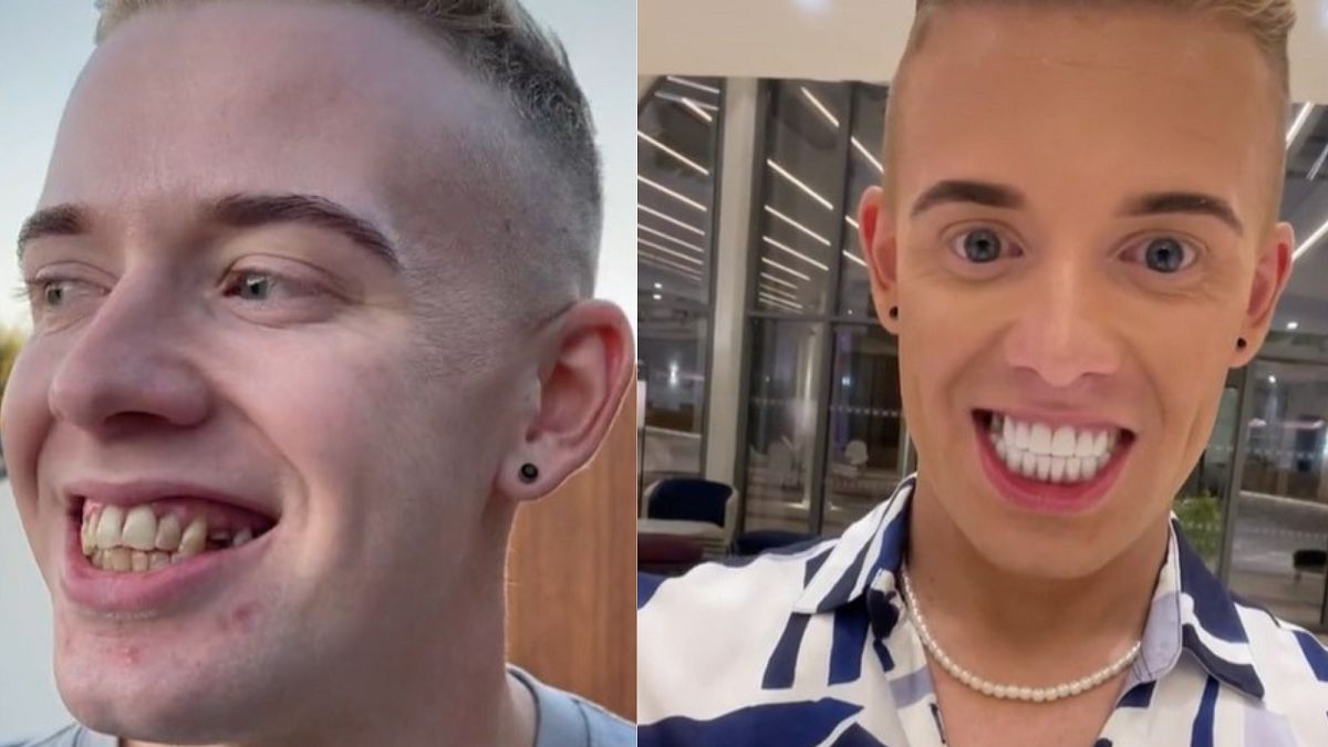 Zrobił sobie "tureckie zęby". Jest zachwycony. 