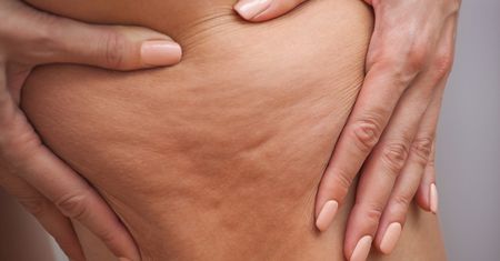 Nowa metoda walki z cellulitem. Wypróbuj "body combing"