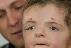 9-letnia Martynka z zespołem Aperta ma nową twarz